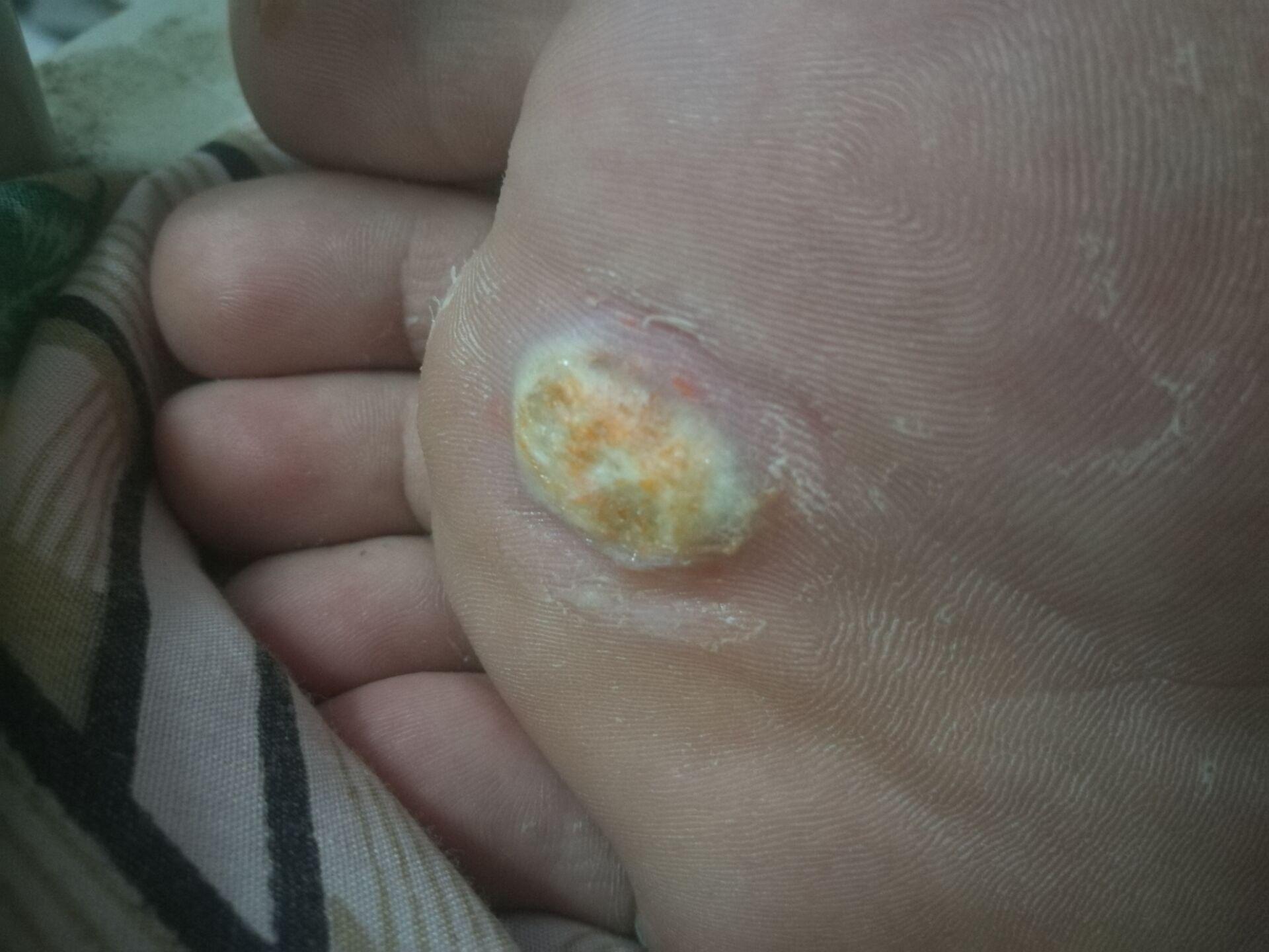 我的鸡眼严重嘛麻烦懂得帮一下忙谢谢您了