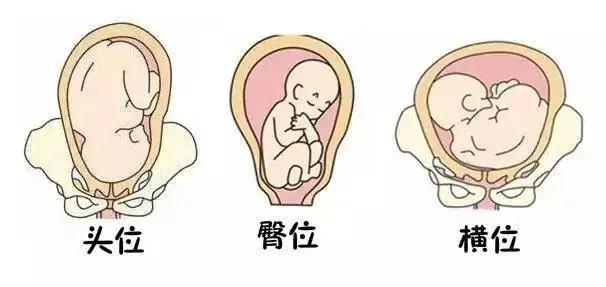 胎位分哪几种? - 知乎