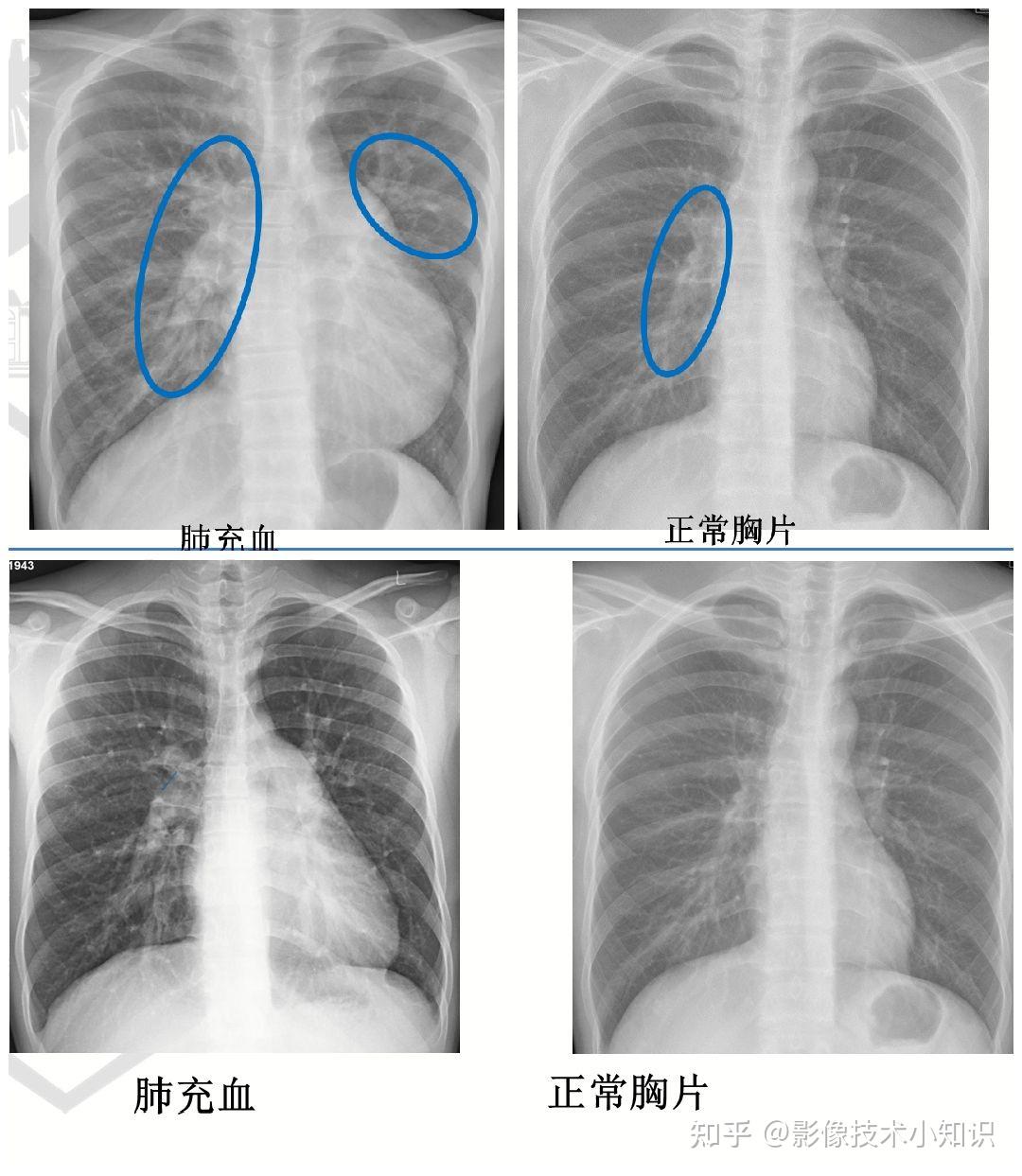 正常心脏x光图片图片