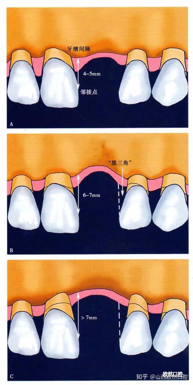 牙槽嵴缺损的美学分类