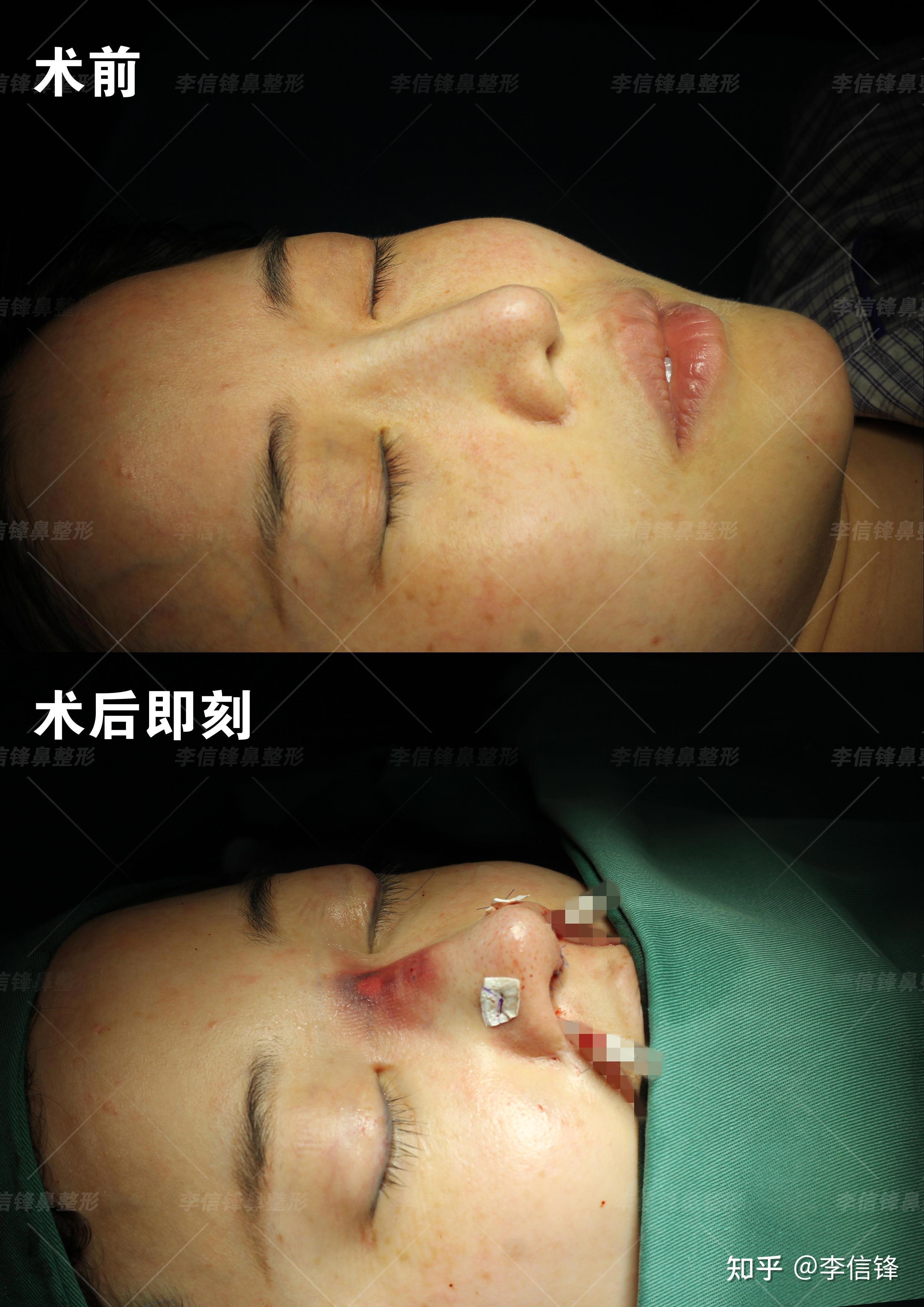 膨体耳软骨鼻综合鼻基底填充术后即刻案例深圳李信锋隆鼻综合整形案例