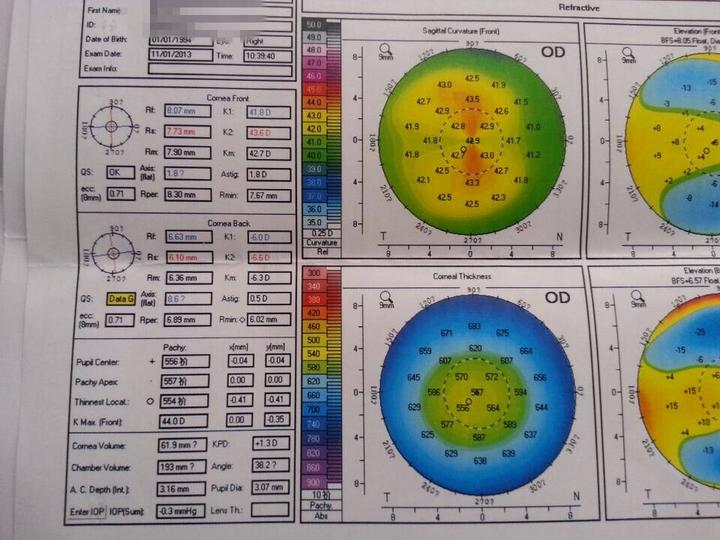 不求人丨教你2步看懂角膜地形图