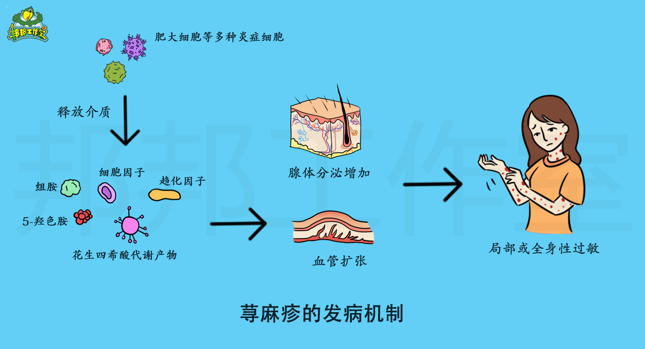 为什么会引起荨麻疹? - 知乎