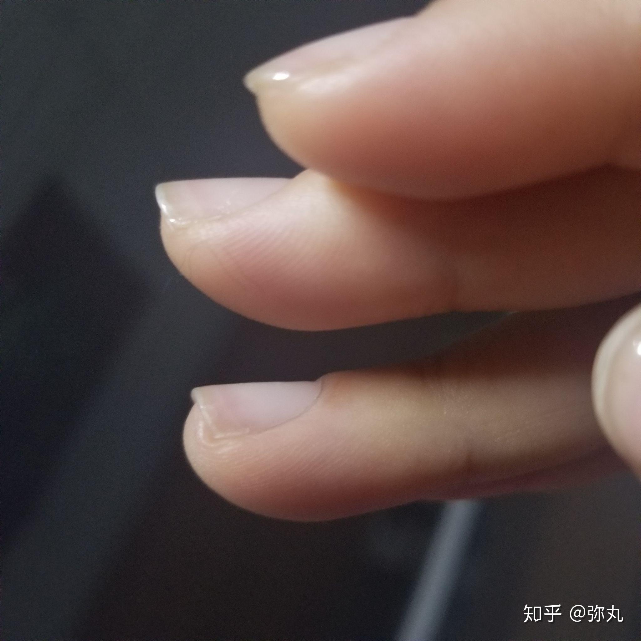 指甲翘起是先天的吗