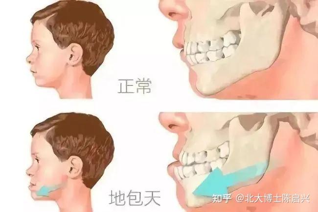 地包天的形成原因是什麼?