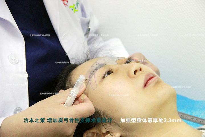 最高点3mm膨体丰眉弓 眉骨舒展自然柔和为大原则 魏洁案例 缓解眼突和颧骨突出度 - 知乎