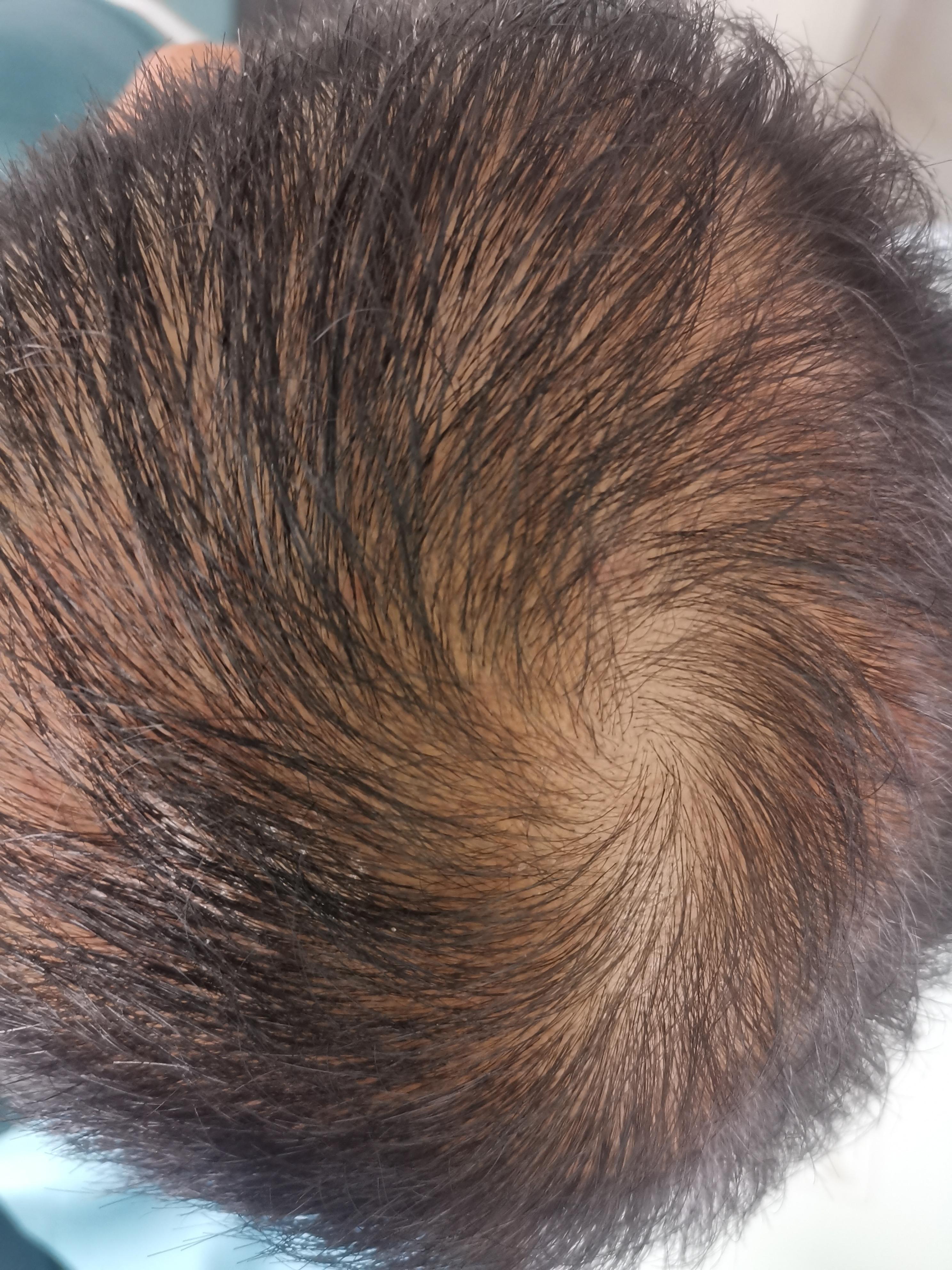 #脱发脂溢性脱发的成因是什么？ 👦👨脂溢性脱发是脱_圈子-新氧美容整形