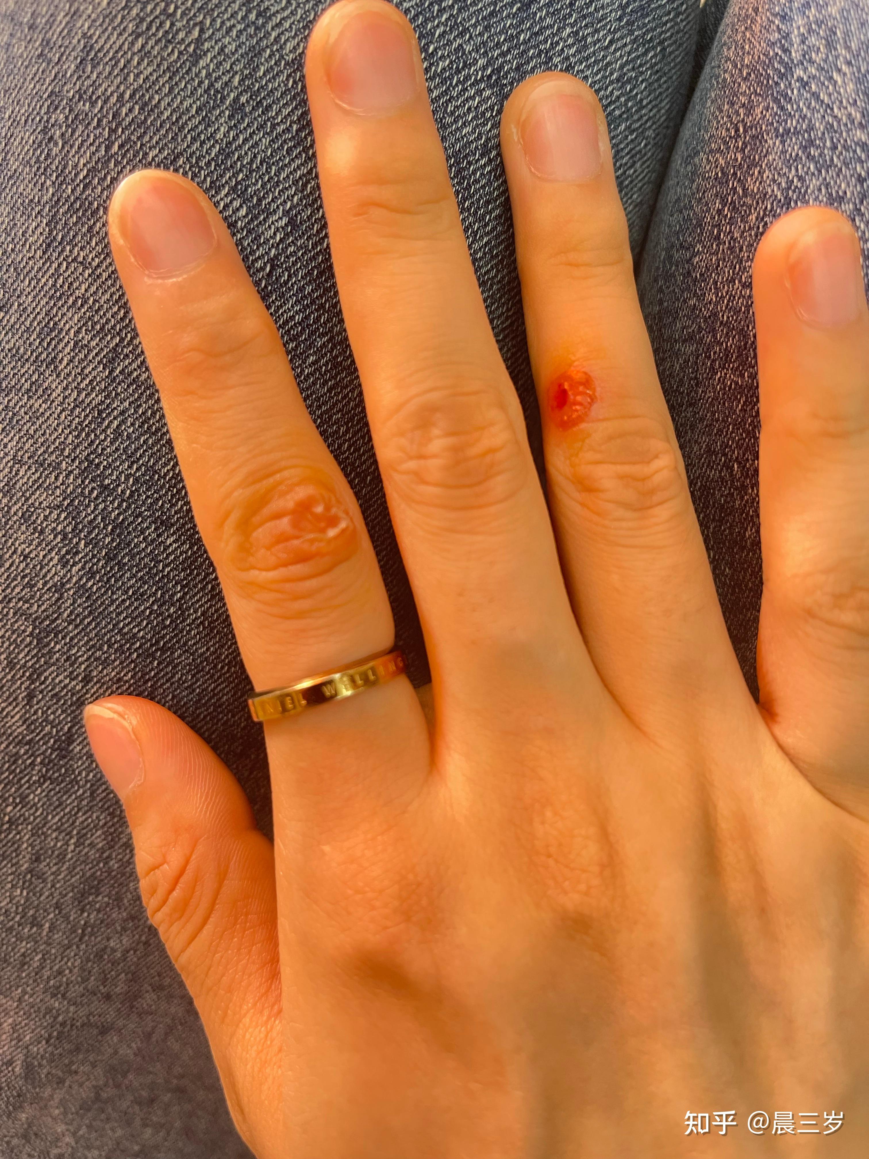 液氮冷冻治疗疣全过程 - 知乎