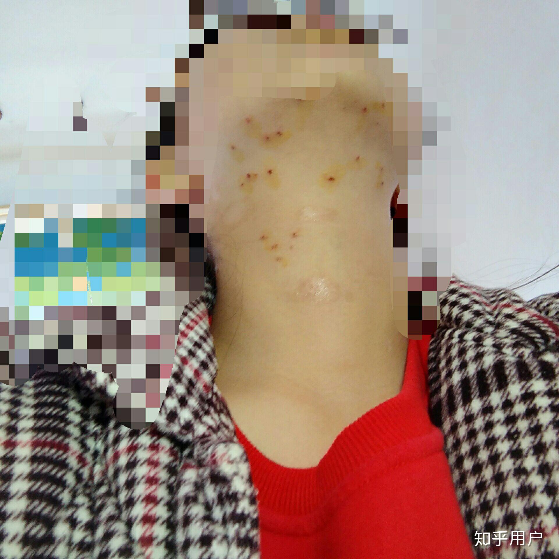 传染性软疣如何根治? - 知乎