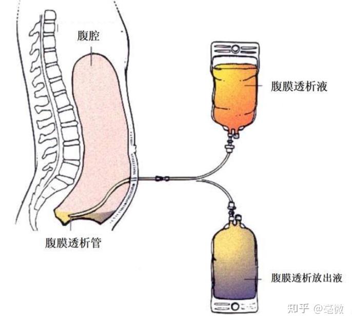 腹膜透析液被放置在腹腔内,与腹膜进行几个小时的接触