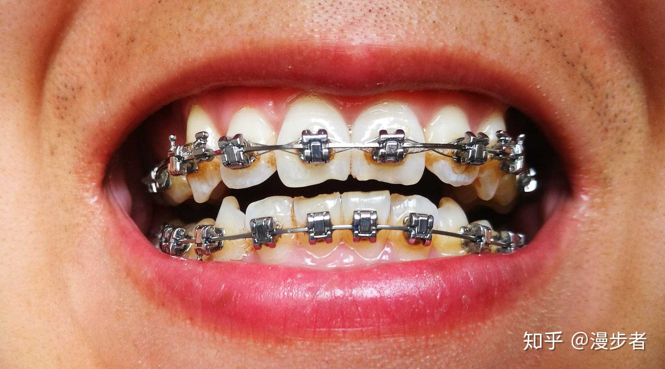 正畸用的进口的自锁托槽和国产的自锁托槽有什么区别? - 知乎