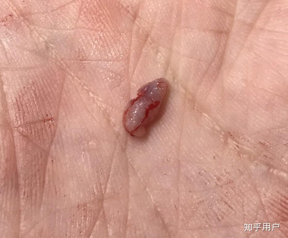 有没有肛内尖锐湿疣治愈的亲啊能说说经历吗