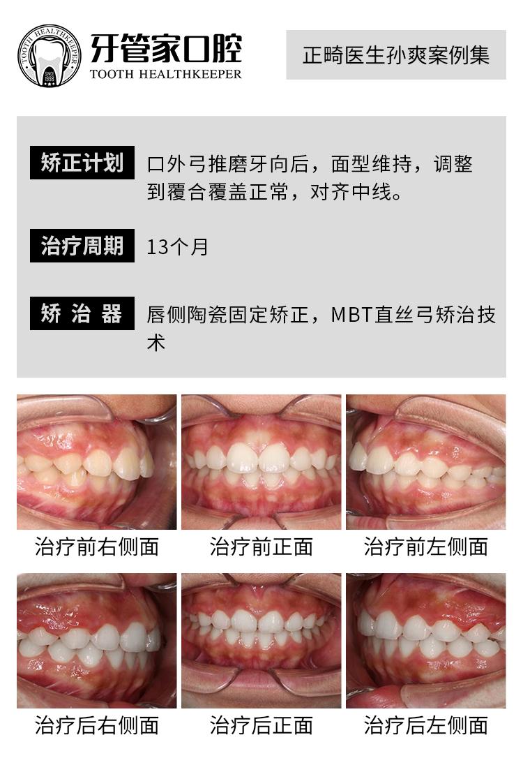 牙齒矯正可以改變臉型麼