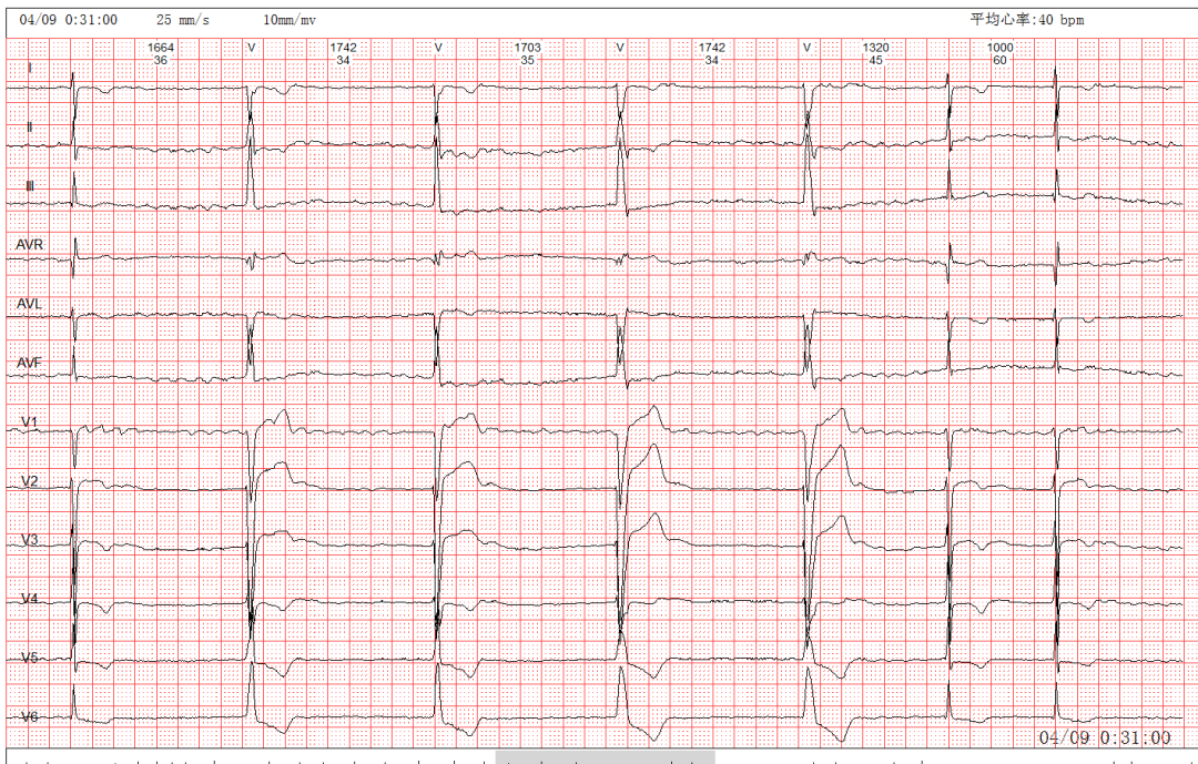 逸搏心电图图片