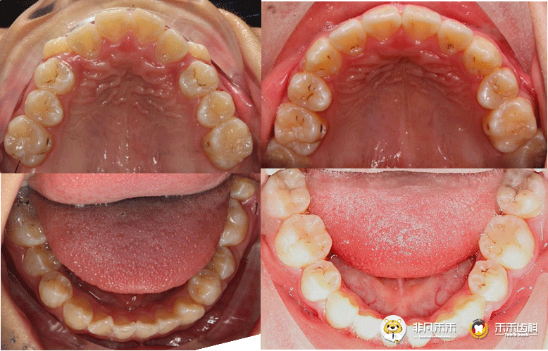 正畸病例青少年拔牙病例1例