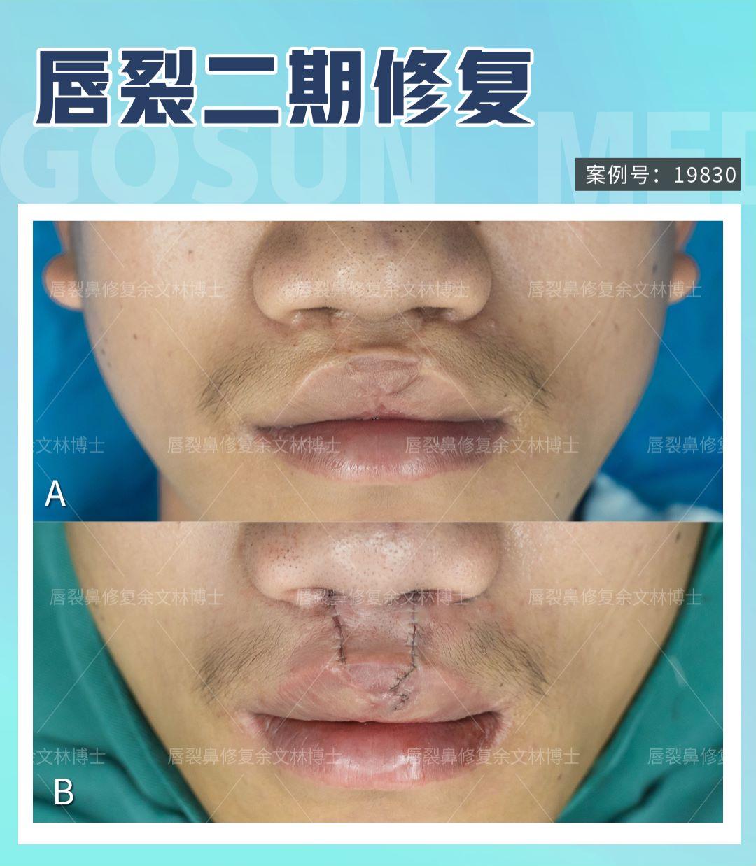 案例分析唇裂患者覺得嘴唇沒形唇畸形修復手術後唇形好看