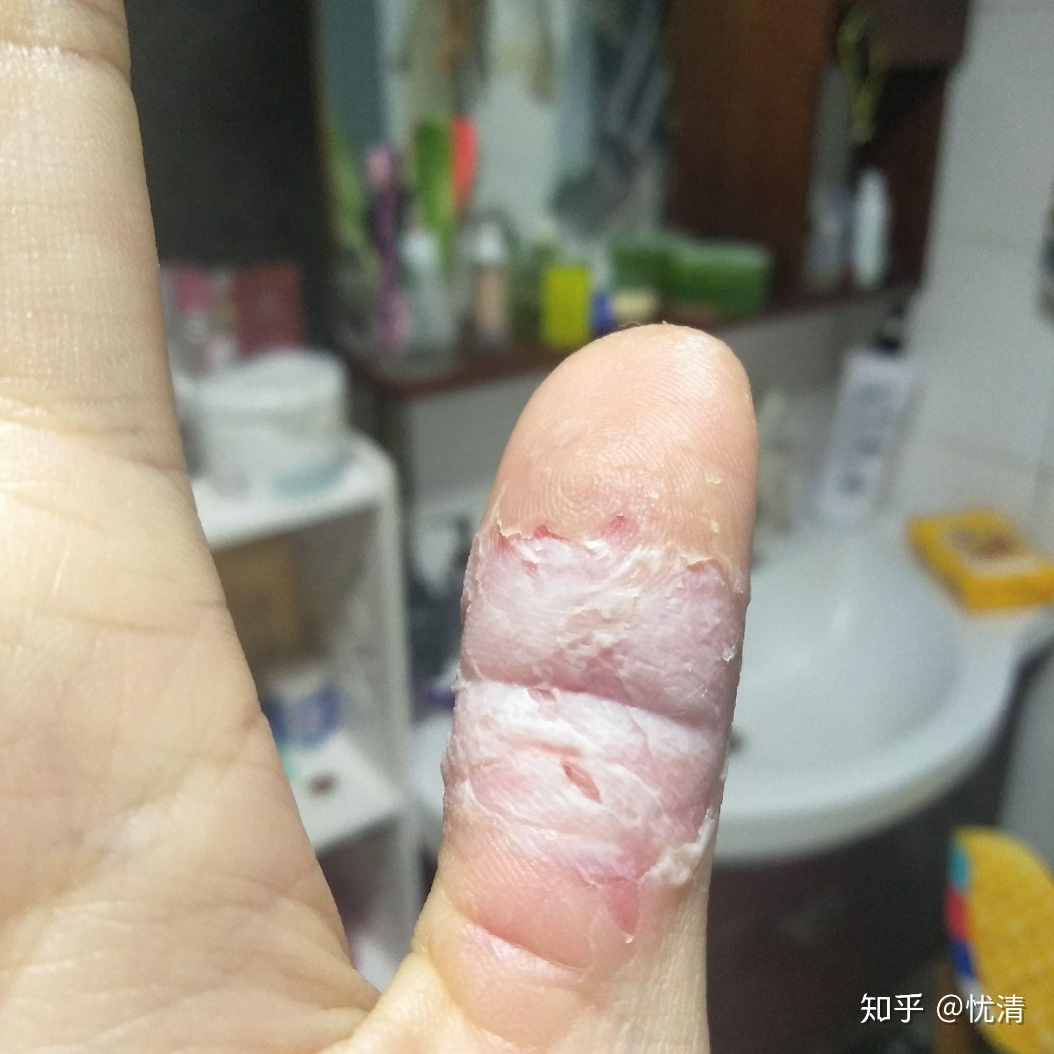 如何控制不自觉的没完没了的撕手皮如何恢复手指皮肤的状态比如已经撕