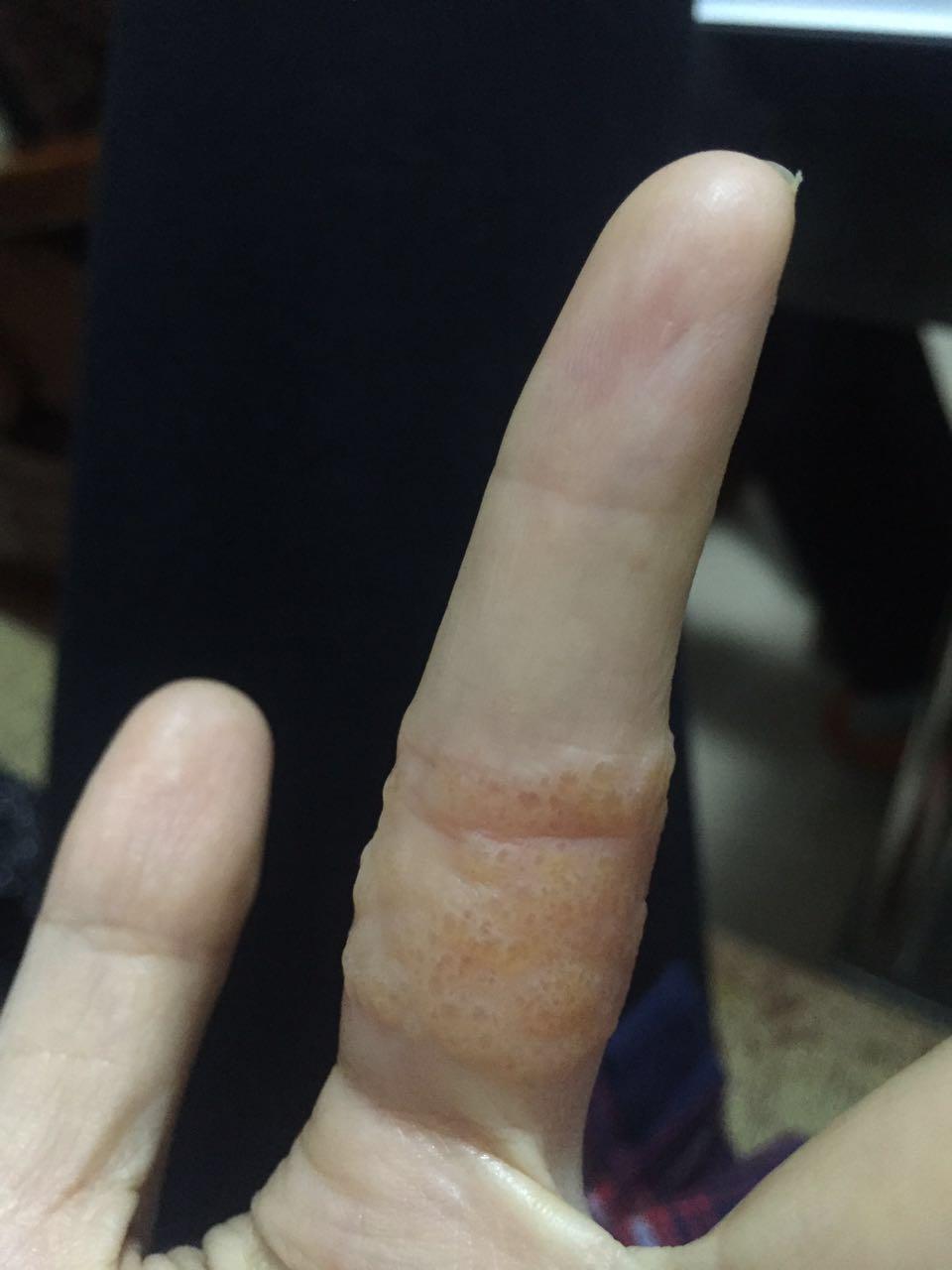 为什么有的人会对创可贴胶布过敏过敏原是什么是过敏吗