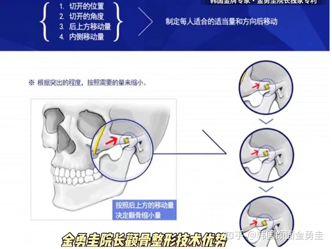 金勇圭颌面美学小课堂(五):颧骨颧弓提升缩小术 - 知乎