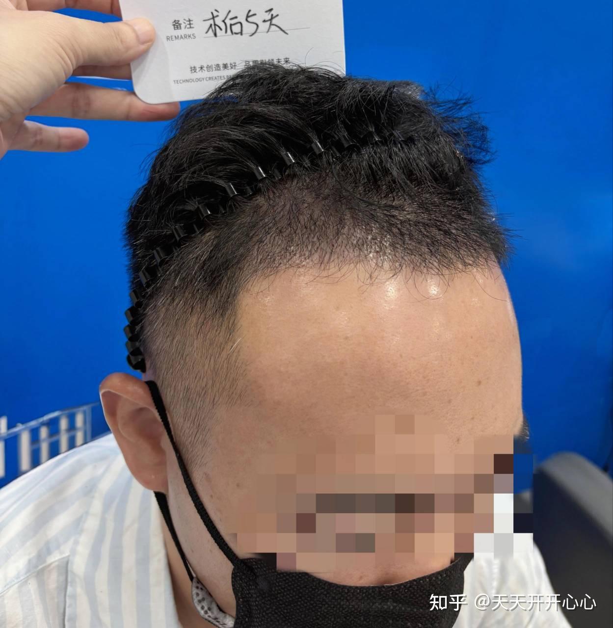 4100单位不剃发植发5天,求问大家一个小问题🙏 - 知乎
