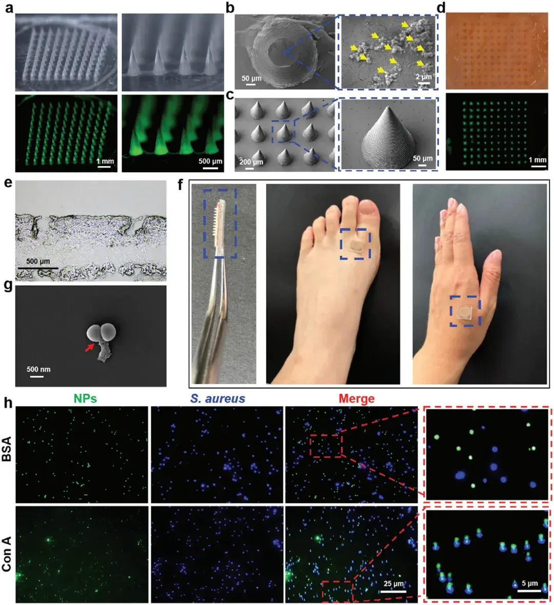 武汉大学研究成果登上《Advanced Materials》期刊——揭秘多功能微针贴片:一氧化氮释放纳米载体助力慢性伤口靶向治疗 - 知乎