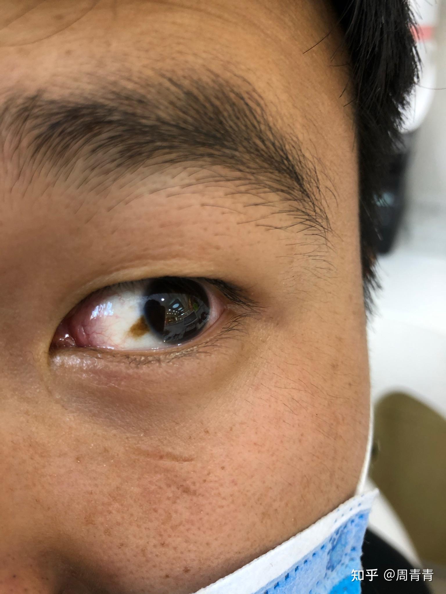 右眼白眼球上有一块黄斑,接近黑眼球了怎么办? - 知乎