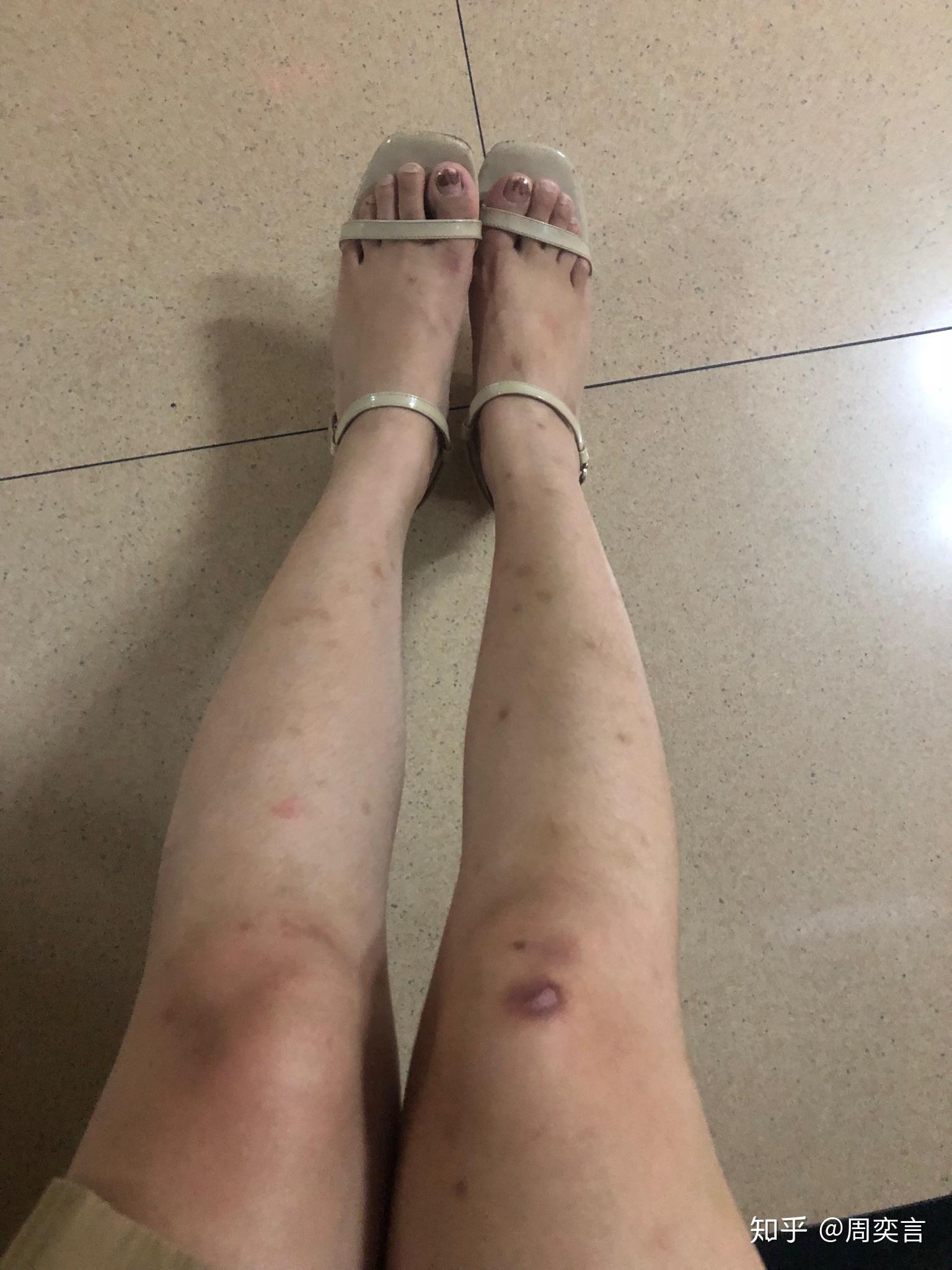 疤痕体质被蚊虫叮咬或者破皮就会留疤怎么办有什么去疤产品比较有用