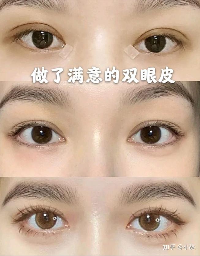 算是这个地区双眼皮必做功课之一吧,风格是自然类型,开扇和平扇形居多