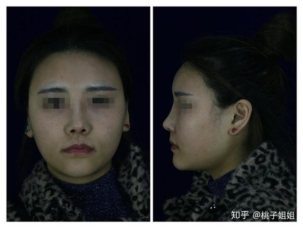 颧骨疼 脸的颧骨疼是什么原因 脸的一侧眼眶和颧骨痛