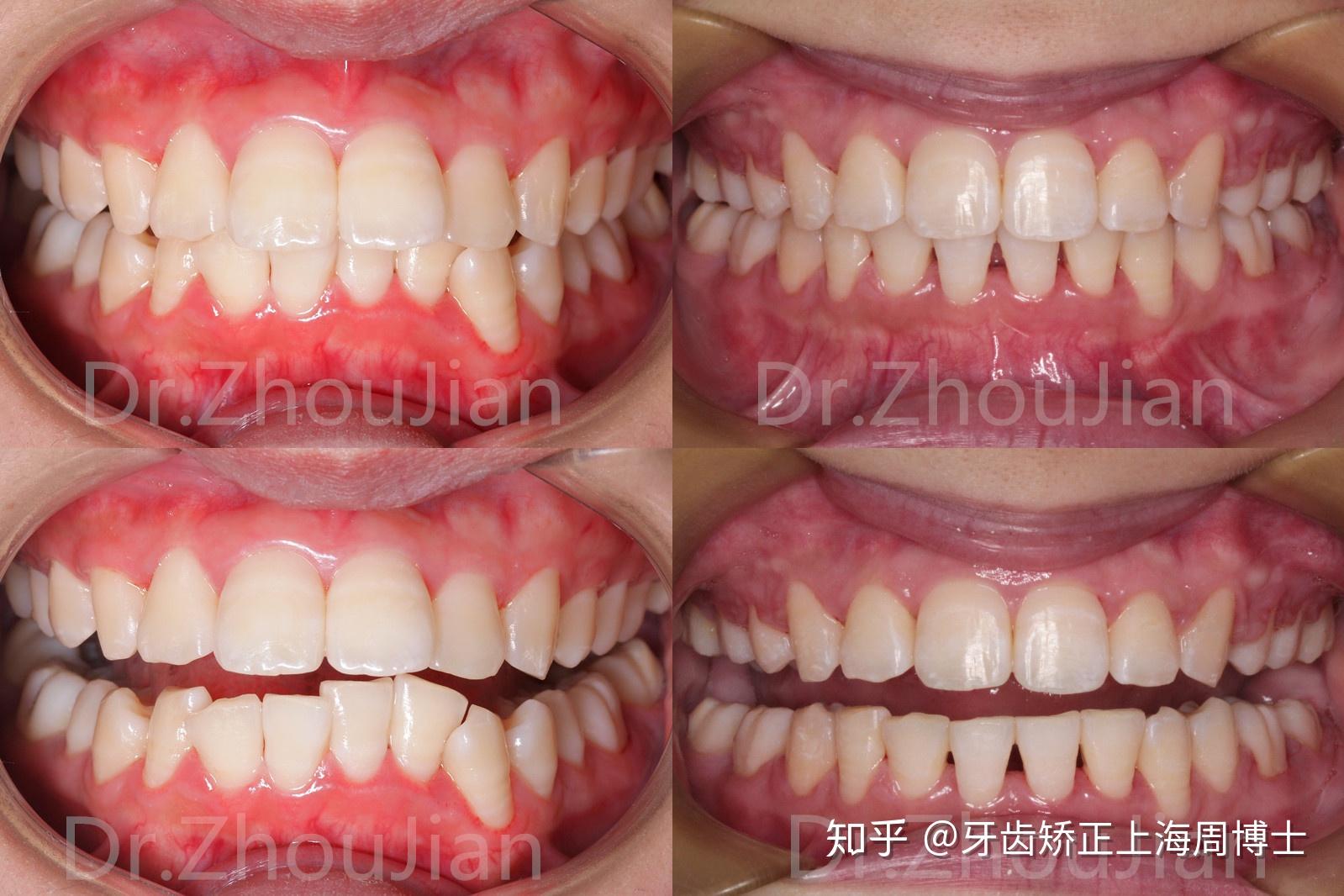 牙齿正畸需要拔掉4颗牙齿之后只剩下24颗牙齿这样正常吗