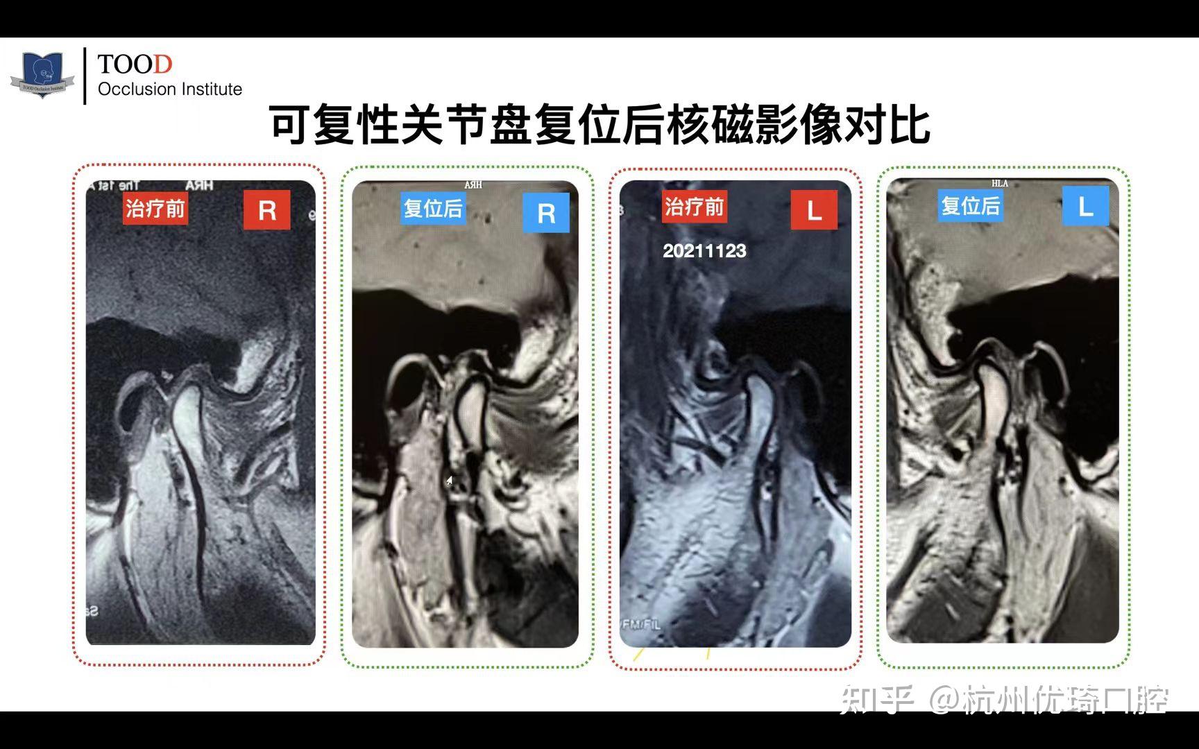 前几日周院长治疗的患者,可复性关节盘移位,复位后的影像对比, 分享