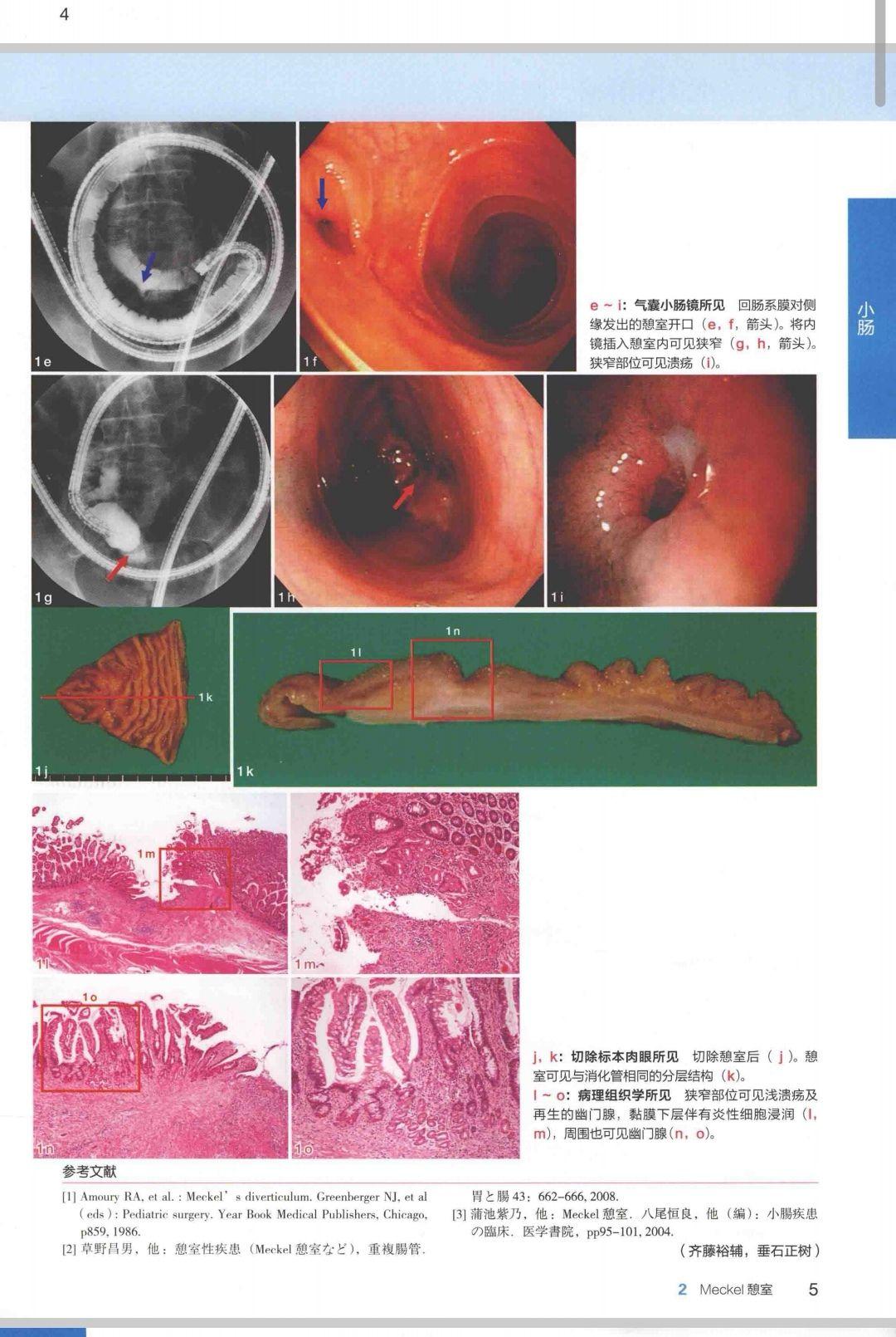 病例4-65 慢性胆囊炎(4)-超声读片-医学