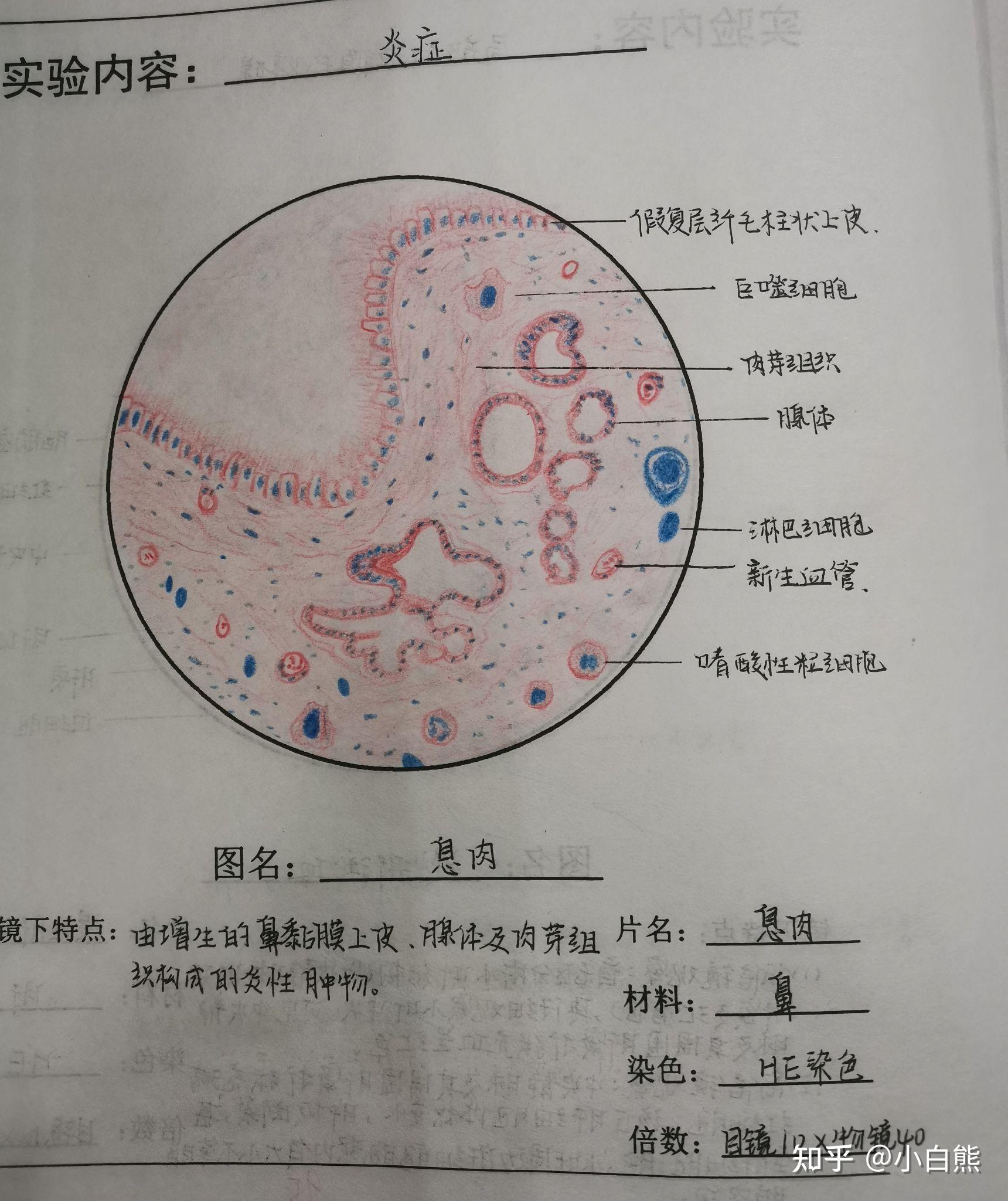 鼻息肉炎症细胞手绘图图片