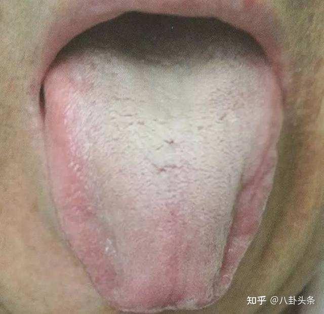 图解:厚白腻苔:舌象为苔色白而厚,颗粒坚紧或疏松,可布满全舌,亦可边
