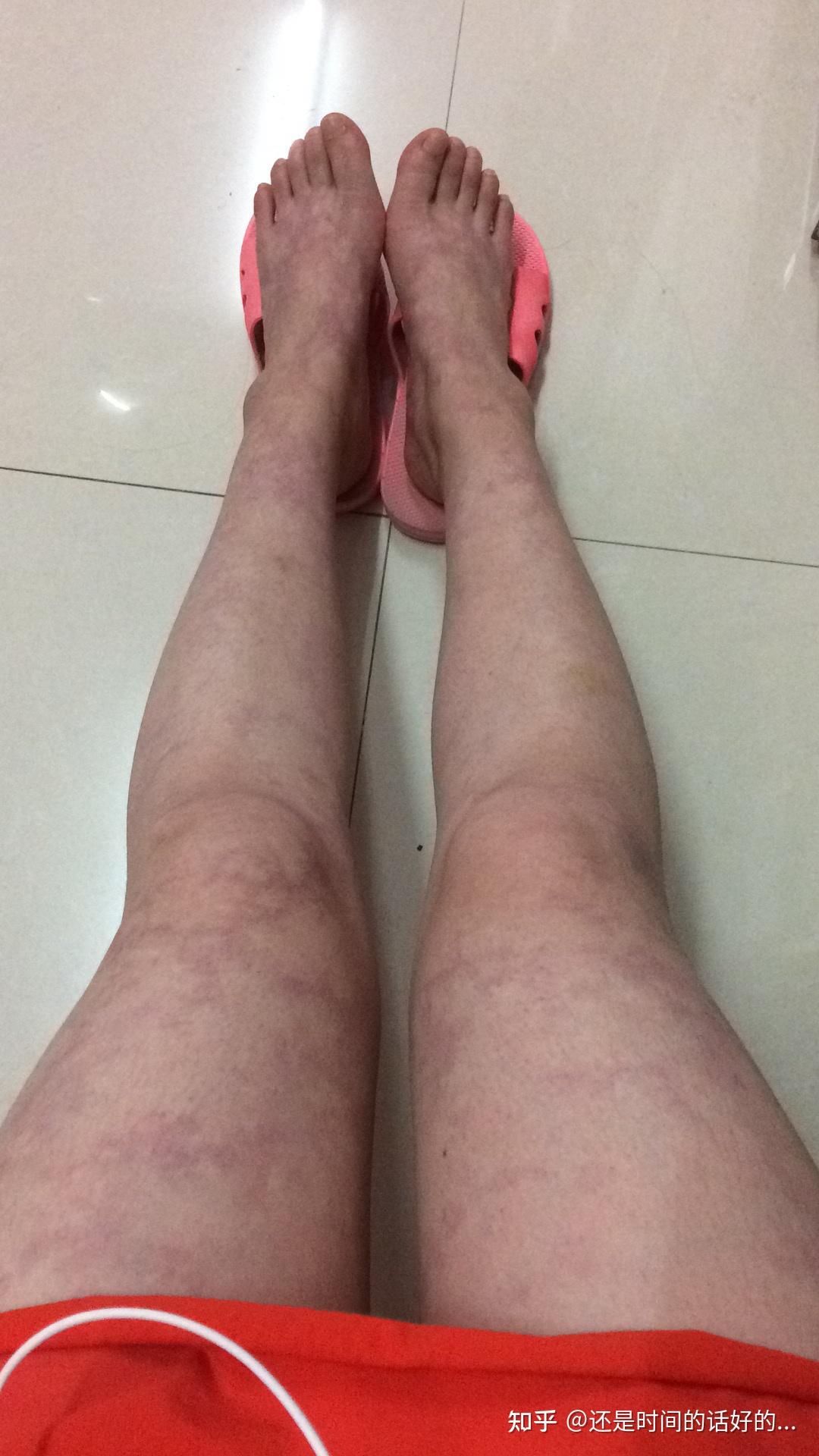 关于网状青斑有懂的人来谈谈吗