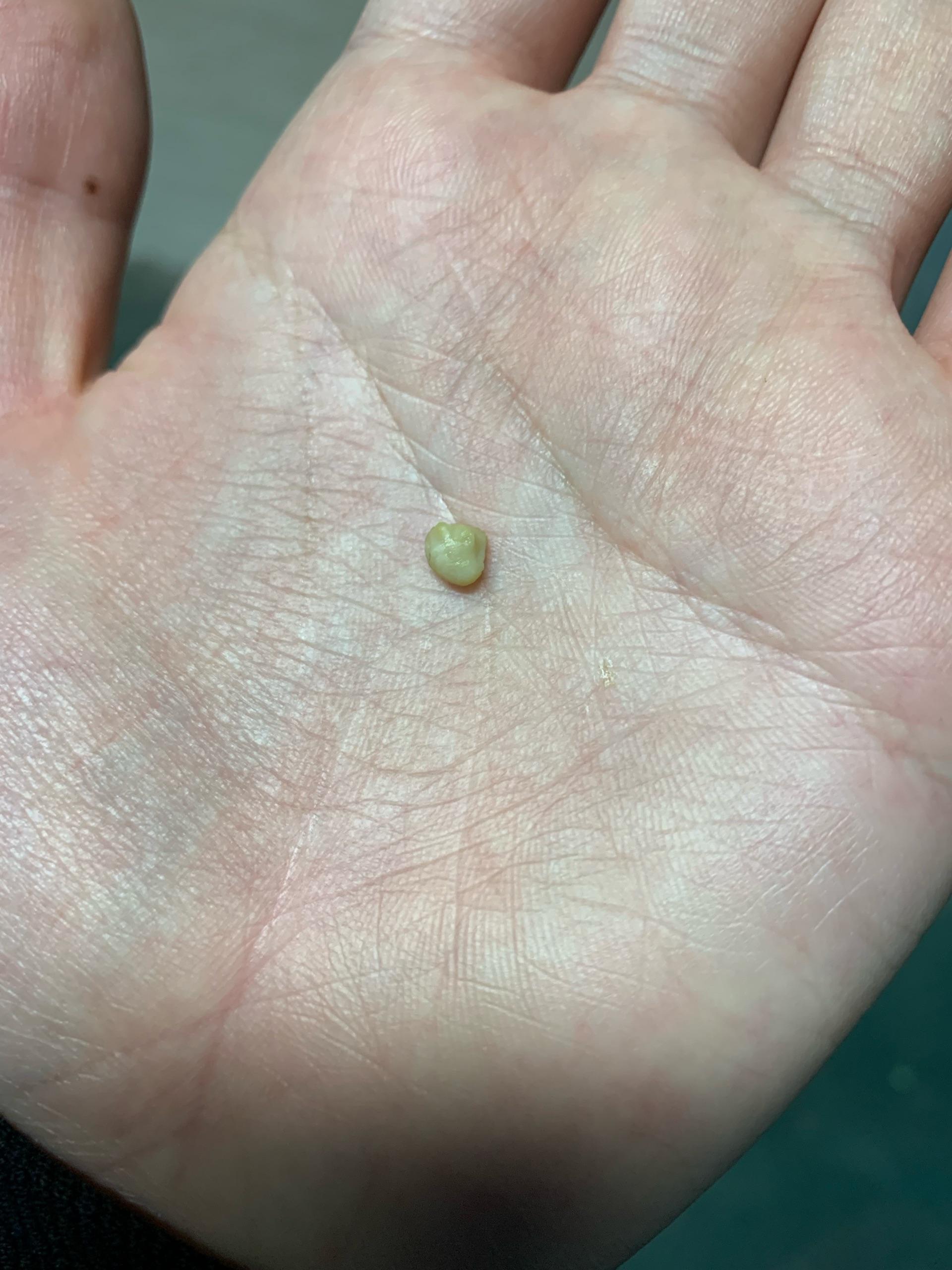 你见过最大的扁桃体结石有多大