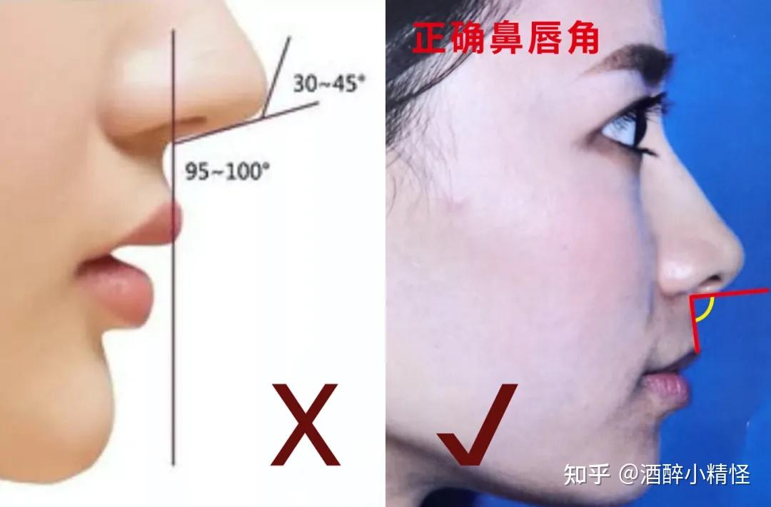 鼻基底垫膨体最全术后功课十年前我整错了哪里