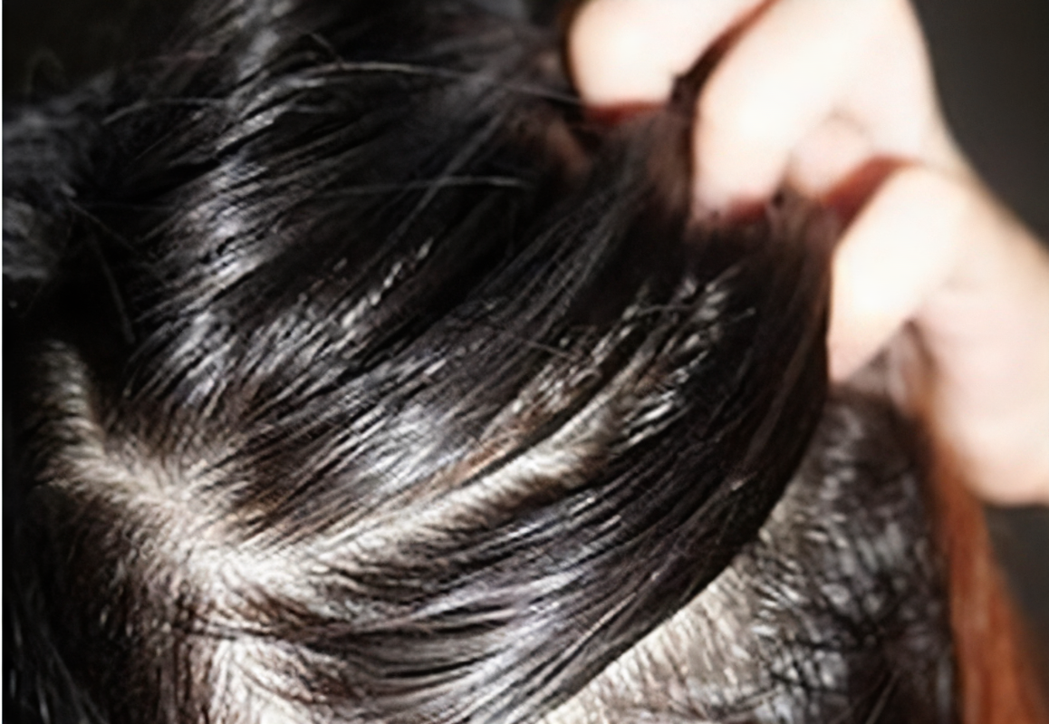头发扁塌油根源:油性头皮和细软发质