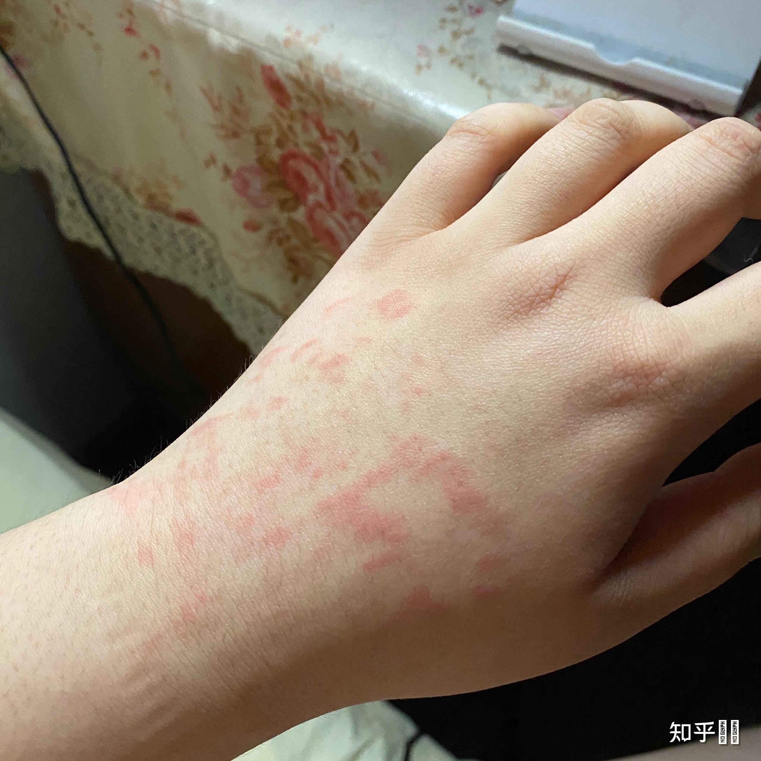 生气,难过的时候喜欢用力掐自己的手或者用指甲抠自己的手,为什么?