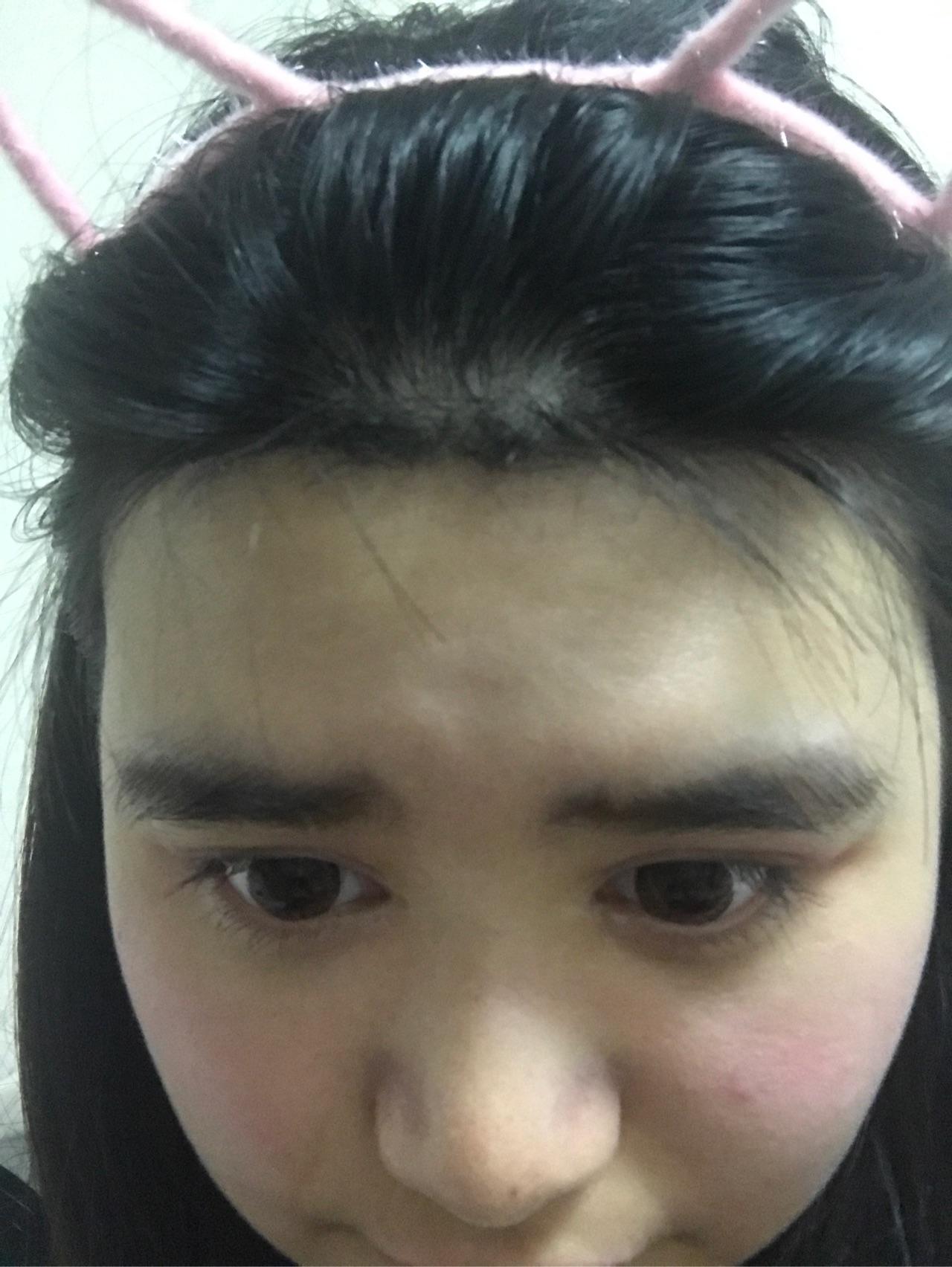 有没有因为额头低而脱发际线的