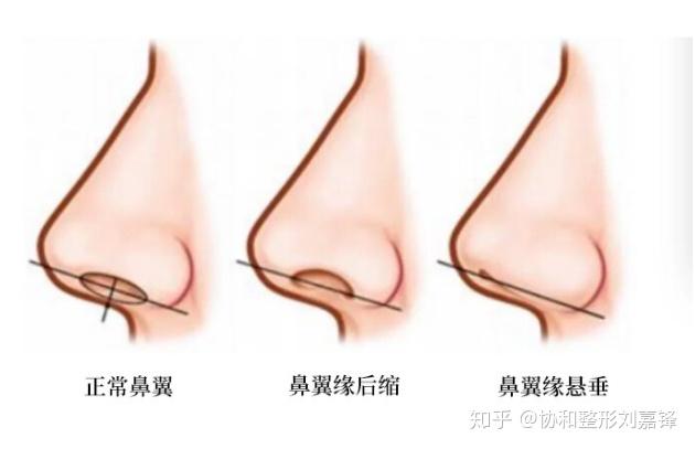鼻翼缘退缩会导致朝天鼻吗
