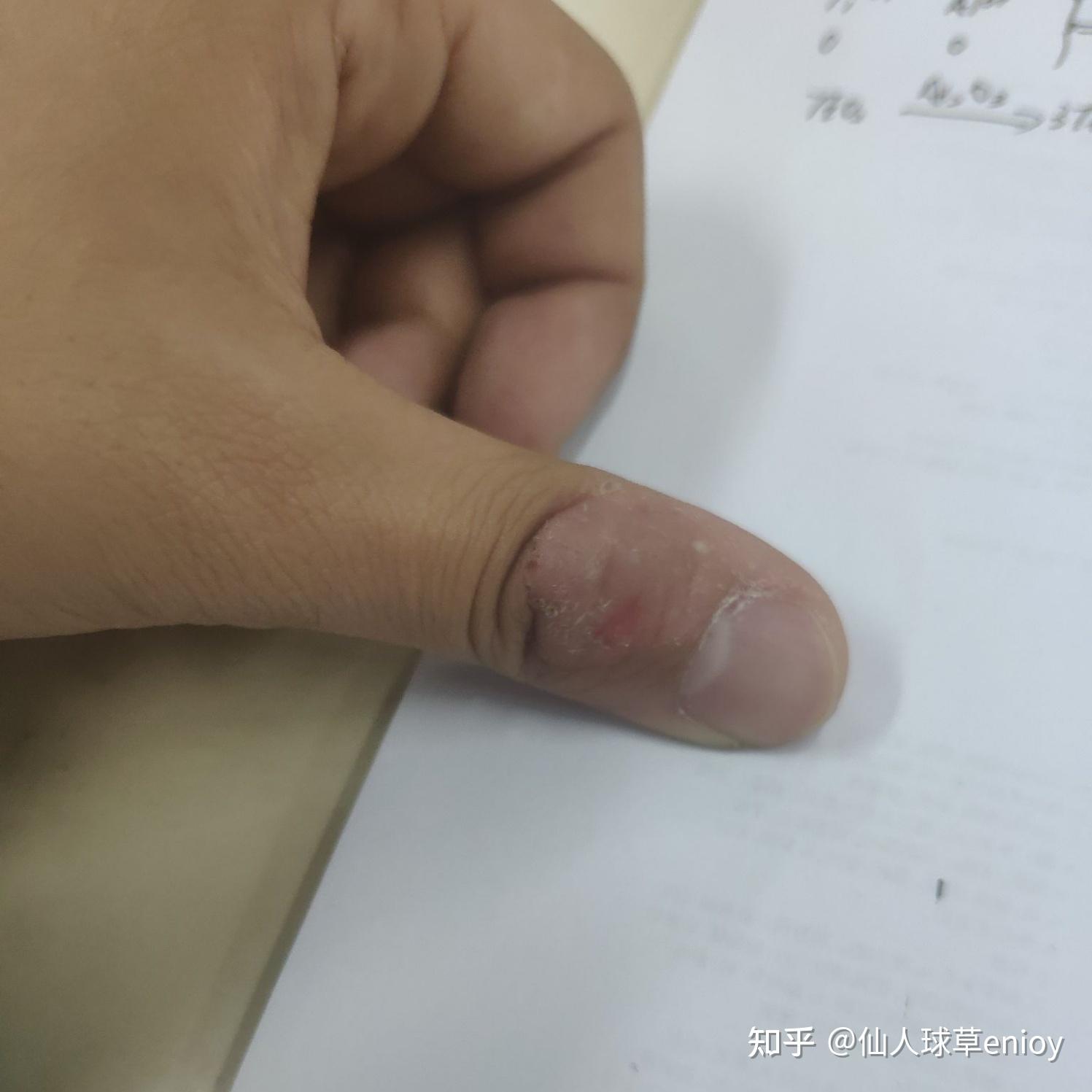 为什么我会喜欢撕手上的倒刺每次都会把自己弄的血淋淋的这是一种病吗