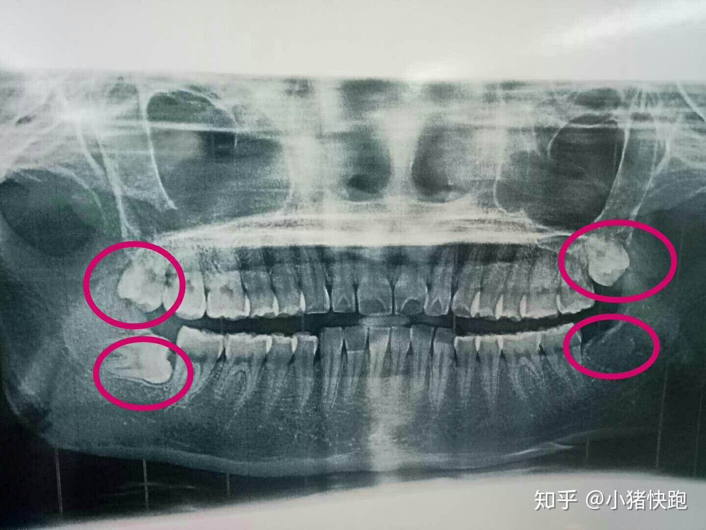 巨型智齿图片