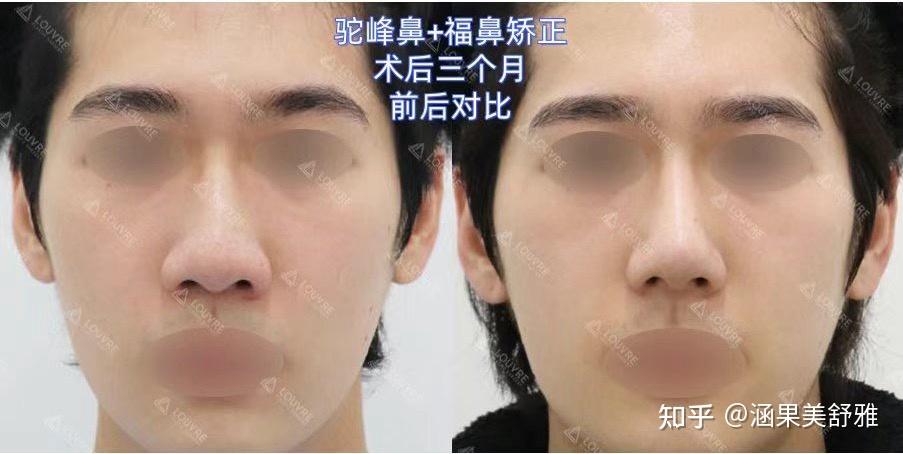 蒜头鼻(福鼻)怎么改善? - 知乎