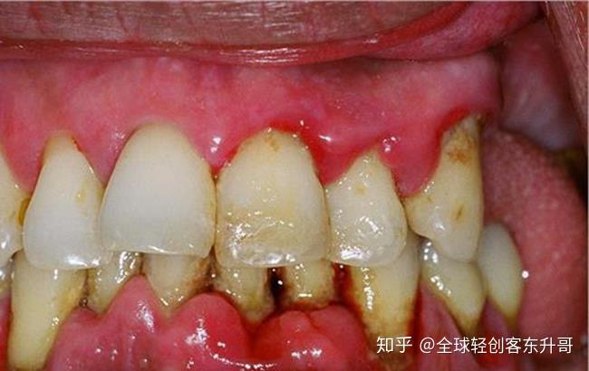 牙龈常见病的图片大全图片