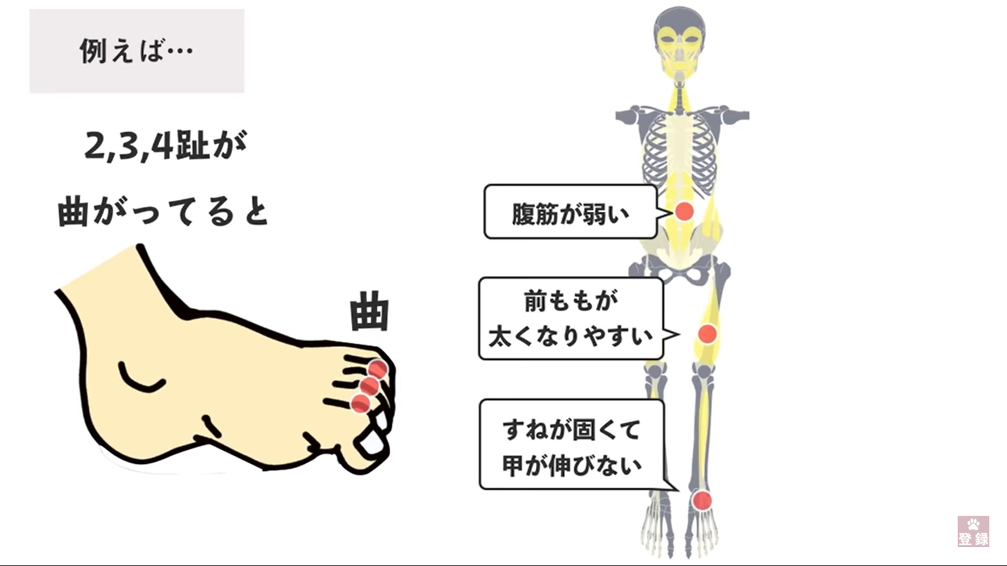 去完整骨院 回家就在亚马逊上买了矫正姿势的拖鞋和鞋垫 知乎