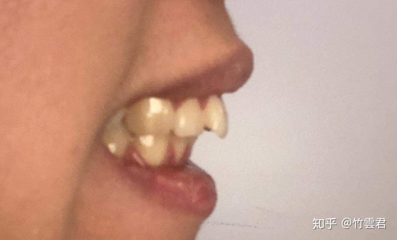 21岁女整牙（正畸）日记 - 知乎