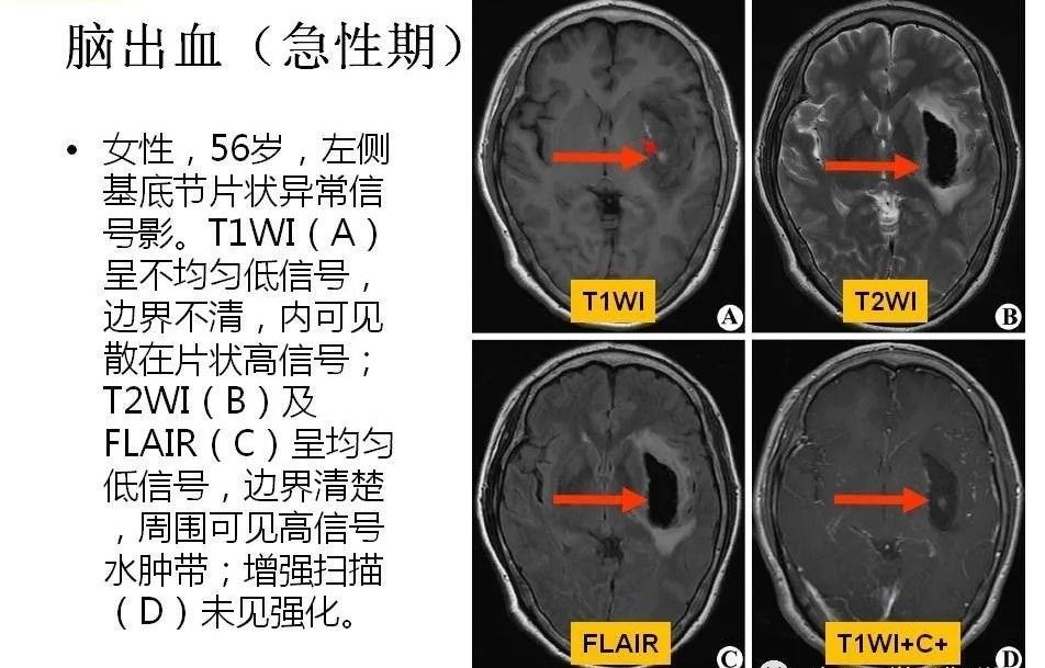 脑出血磁共振图片图片