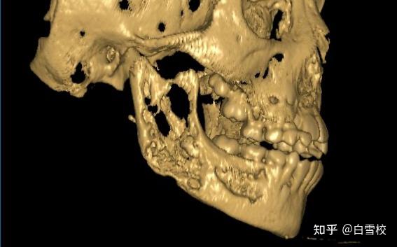 下颌骨弥漫硬化性骨髓炎——一种特殊类型骨髓炎的发现记