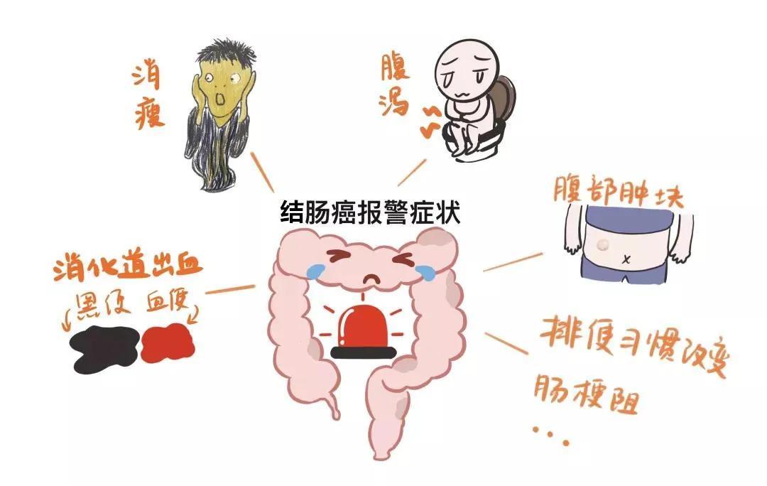 出现这种症状警惕结肠癌 知乎